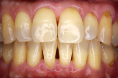歯周病症例写真２−治療後