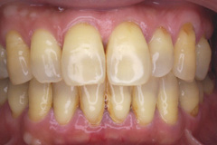 歯周病症例写真２