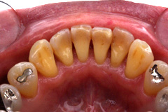 歯周病症例写真１−治療後