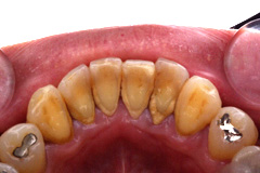 歯周病症例写真１